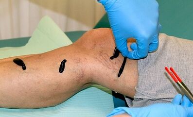 Varicose veins үчүн хирудотерапия