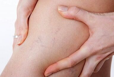 varicose тамырлары үчүн аракеттенүүгө тыюу салынган