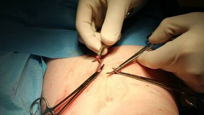 Варикоздук тамырлар үчүн Flebectomy