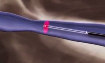 Термикалык дарылоо